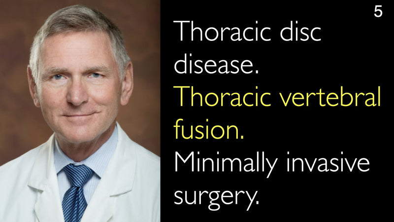 Thoracic disc disease. Thoracic vertebral fusion. Minimally invasive surgery. 5